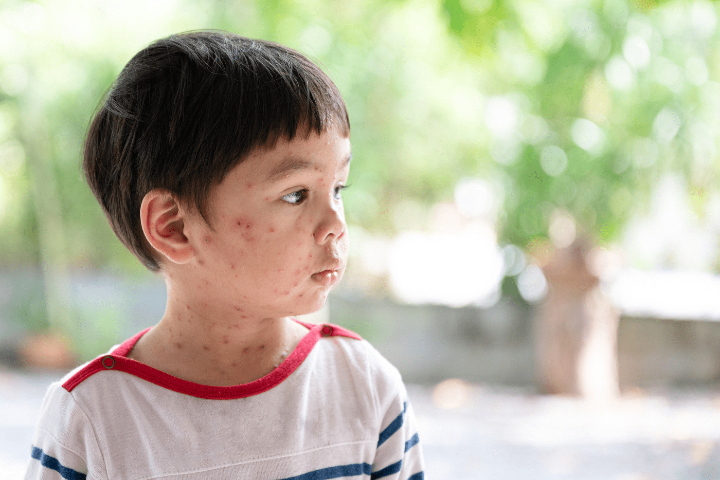 Chicken Pox, Kenapa Cacar Air Hanya Kerap Berlaku Kepada Golongan Kanak-Kanak?