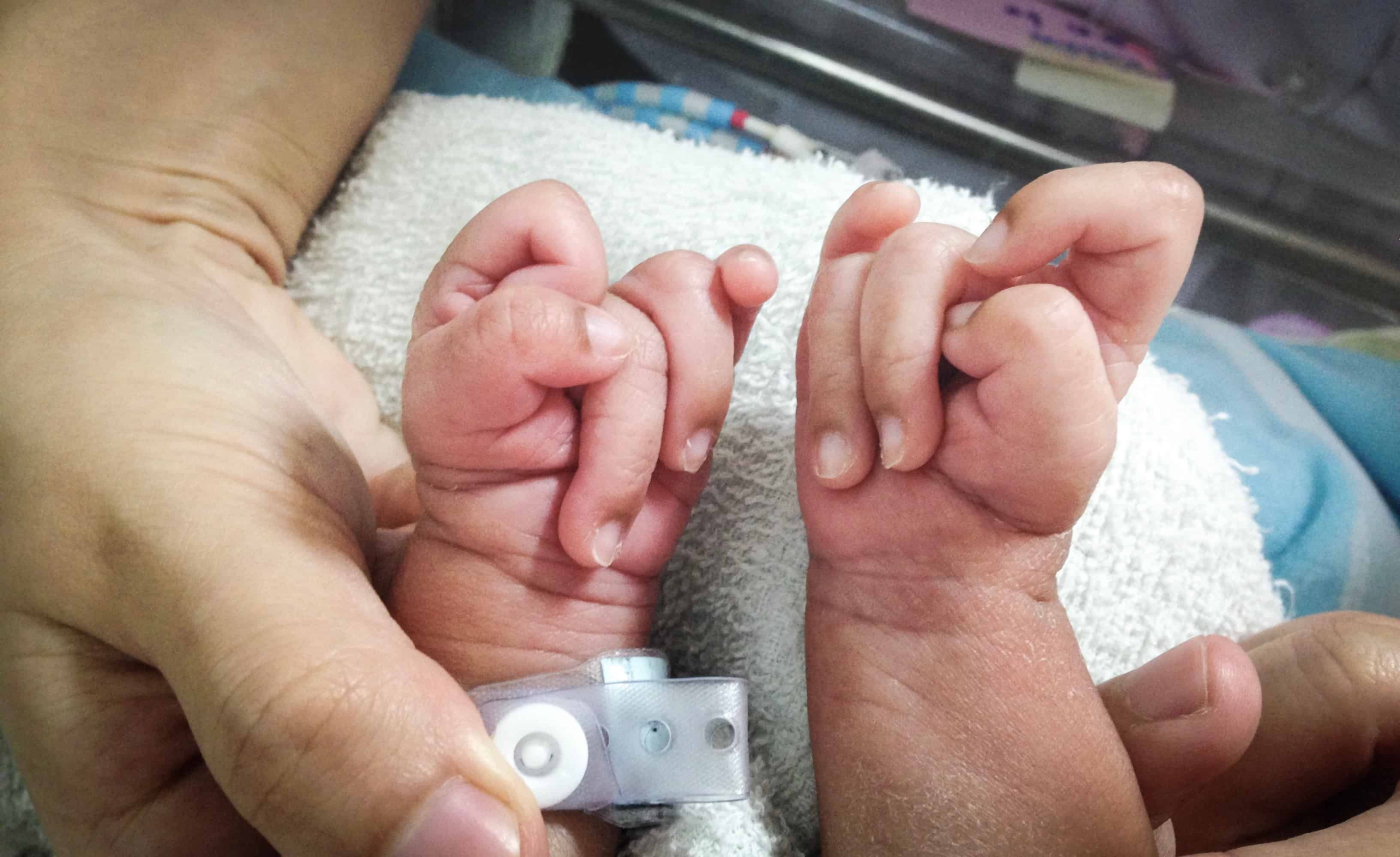 Sindrom Edward: Hanya 50% Bayi Dilahirkan Hidup