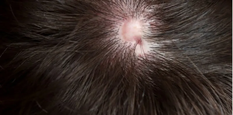 Sejak Lahir Terdapat Ketiadaan Kulit Di Bahagian Tertentu, Kenali Apa itu Aplasia Cutis Congenita