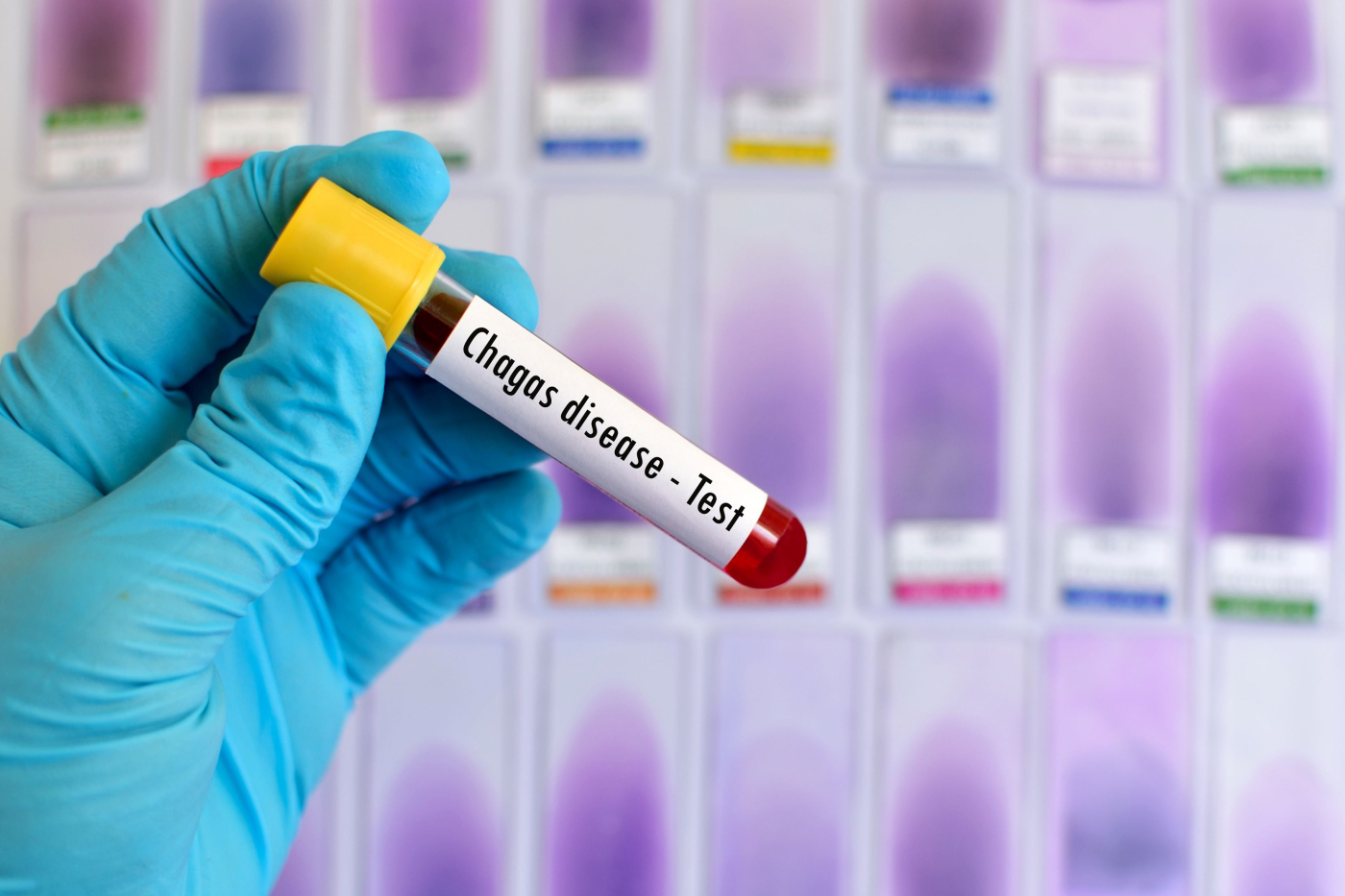 Penyakit Chagas: Jangkitan Parasit Bawaan Pepijat