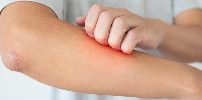 Kulit Gatal Mungkin Tanda Penyakit Organ Hati? Ia Kondisi Bernama Pruritus!