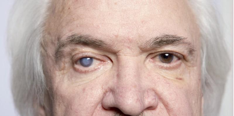 Masalah Mata Buta Atau Glaukoma Boleh Tercetus Kerana #6 Sebab Ini, Jom Kenalinya!