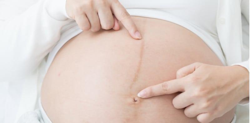 Garis Hitam Di Perut Ketika Hamil Penentu Jantina Bayi, Benarkah?