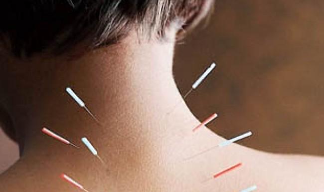 Benarkah Rawatan Akupuntur Berkesan Merawat Ketidaksuburan?