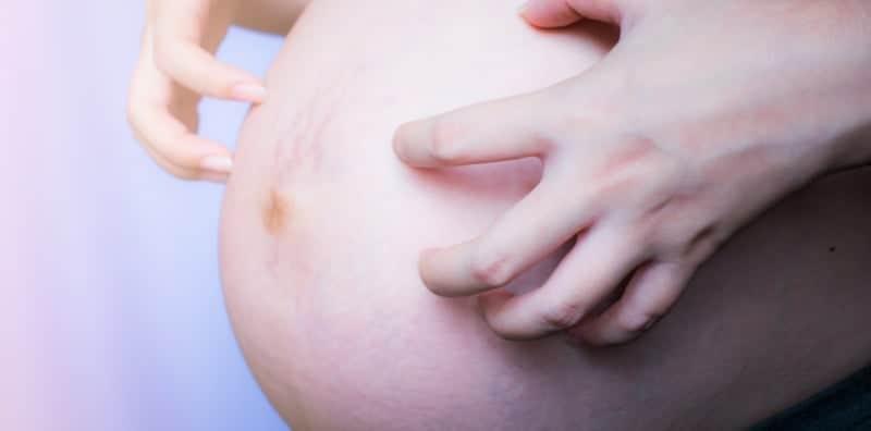 Punca Kesan Regangan Kulit Terjadi? Ternyata, Kehamilan Itu Memang Punca Utama!