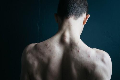 Penyakit Grover: Keadaan Kulit Berbintik Kecil dan Merah