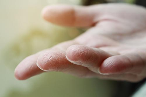 What Causes Skin Moisture Loss