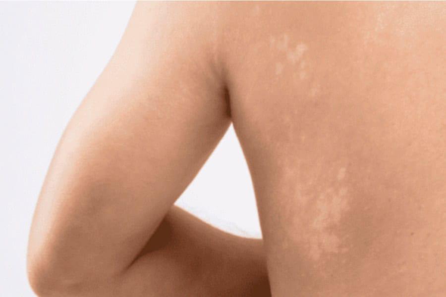 Lepas Berpeluh Terus Mandi Punca Panau Naik Di Badan? Cuba 6 Petua Ini Untuk Hilangkannya!