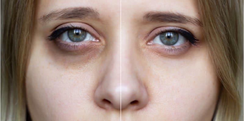 'Eyebag' Bawah Mata Sebab Tak Cukup Tidur? Ini 10 Punca 'Mata Panda'