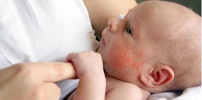Betul Ke Gula Ada Kaitan Dengan Ekzema Pada Bayi? Patutlah 3 Makanan Ini Jadi Pencetusnya!