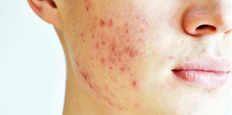 Pakai Produk Hebat Tapi Parut Jerawat Susah Nak Hilang, Ini PUNCA Utamanya!