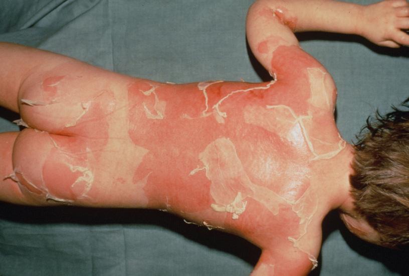 Sindrom Kulit Lecur Stafilokokus, Menyerupai Kulit Terbakar