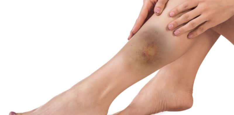 Mengapa Badan Anda Boleh Tiba-Tiba Lebam? Ini Dia Punca & Cara Rawatannya!