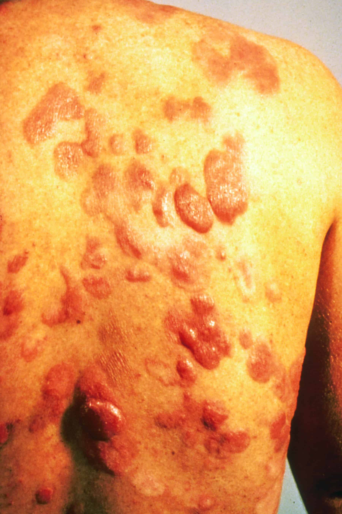 Kaposi’s Sarcoma And Its Variants