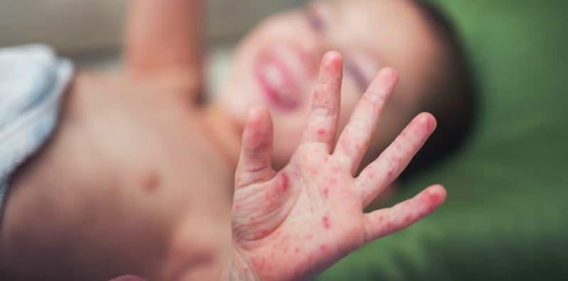 HFMD Dan 5 Penyakit Kulit Biasa, Namun BAHAYA Jika Terjadi Pada Kanak-kanak!