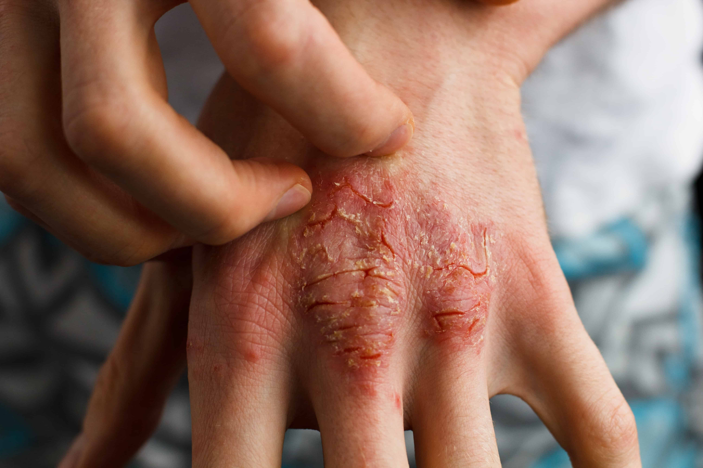 Update On Current Management of Psoriasis