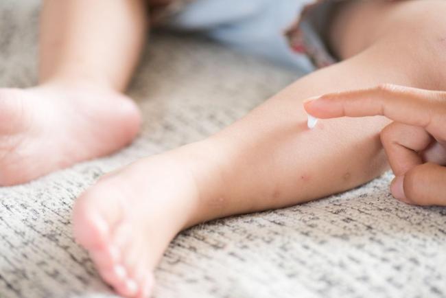 Ini Kaedah Untuk Rawat Cacar Air @ Chicken Pox Anak Di Rumah!