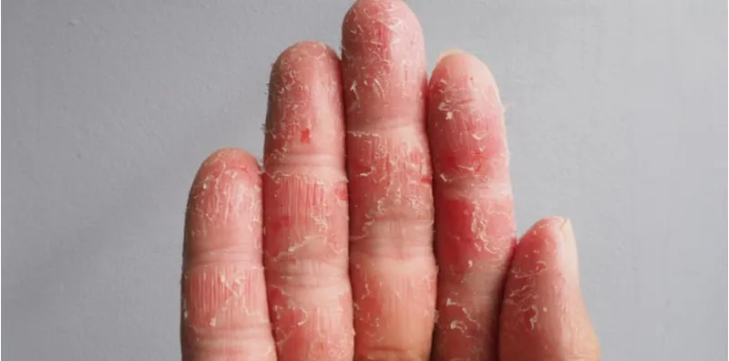 Ini 6 Punca UTAMA Ekzema, Patutlah Tangan Sering Gatal-Gatal & Kemerahan!