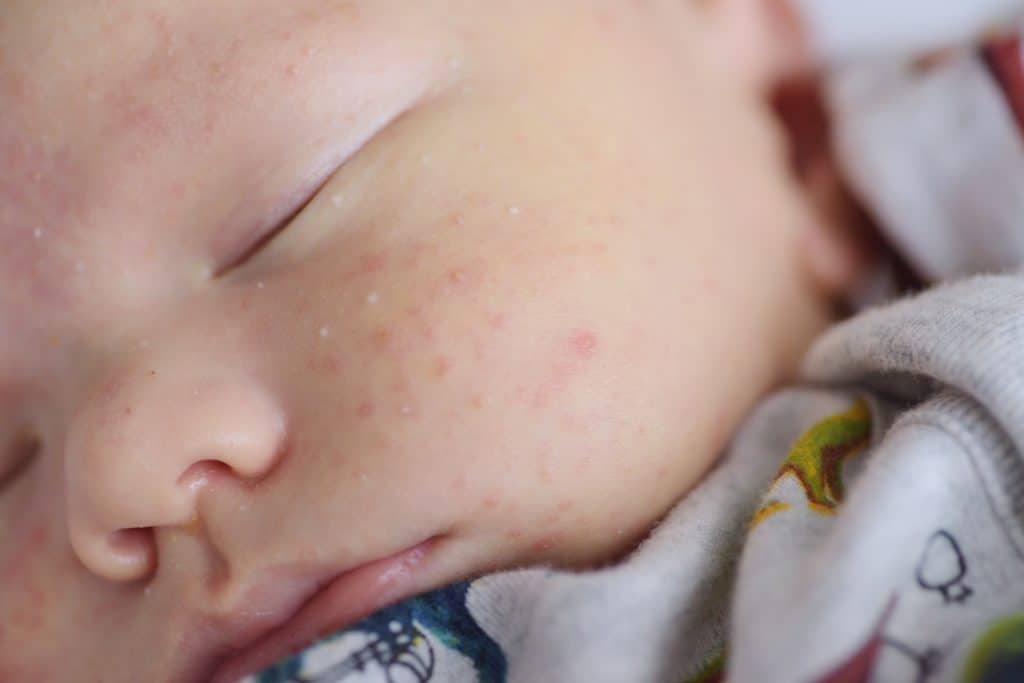 Penjagaan ‘Baby’ Comel, Jangan Ambil Mudah - keadaan kulit