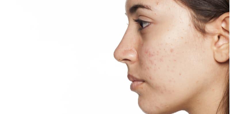 Bekas Jerawat Ganggu Kecantikan Wajah? Guna 10 Cara Ini, Ada Yang Cuba Kata Berkesan!