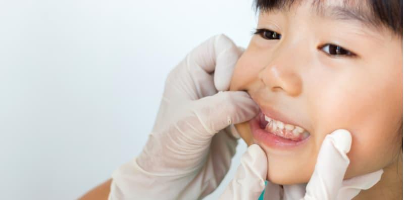 Gigi Anak Berlapis? Ini Puncanya Yang Ibu Bapa TAK SEDAR