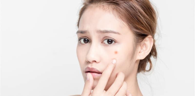 Ambil Tahu Punca & Jenis Jerawat Yang Tumbuh Di Wajah Anda, Senang Nak Rawat Nanti!