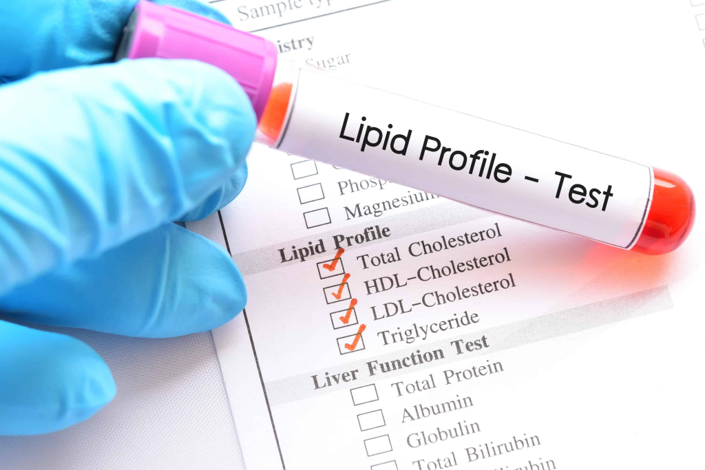 lipid profile test