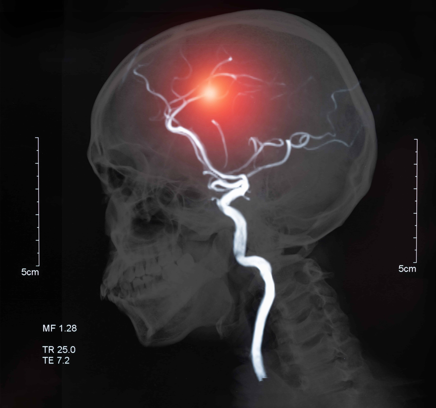 Cerebral Venous Thrombosis
