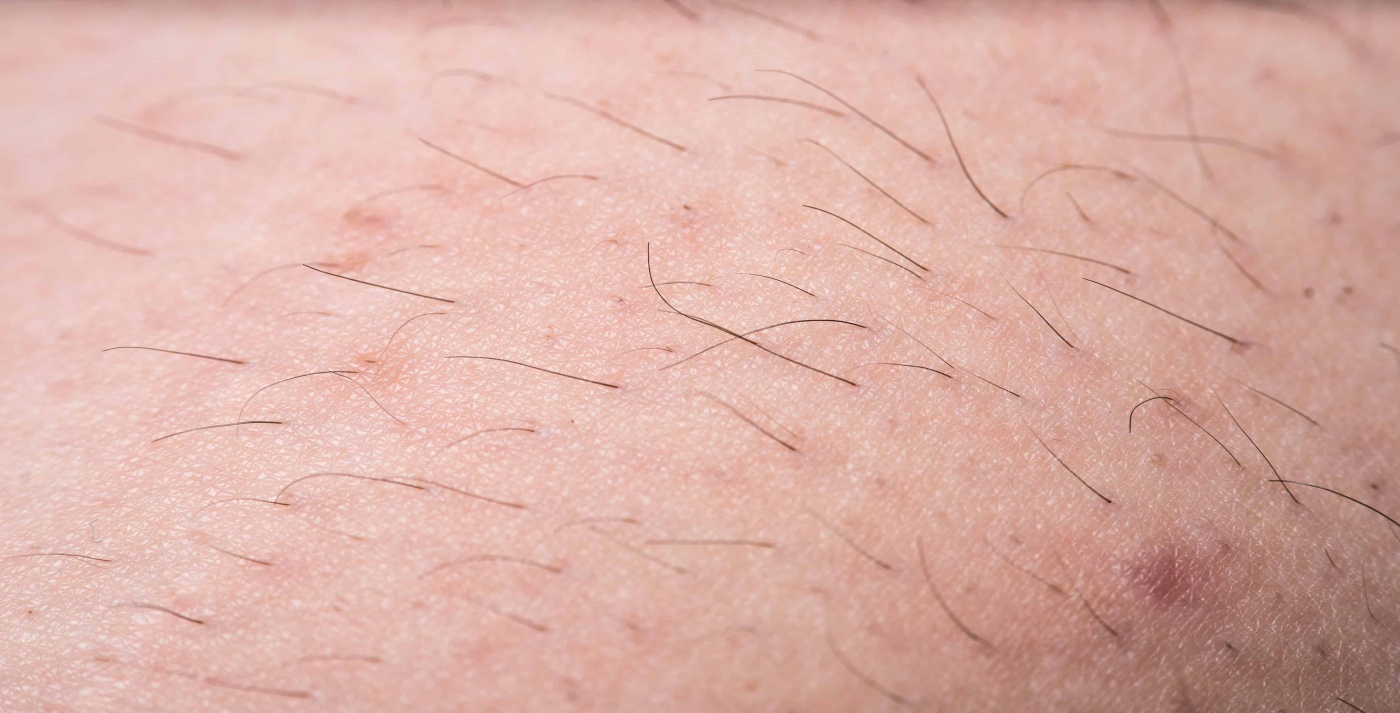 “Bulu Badan Banyak Sebab Hormon Tinggi Lah Ni”. Betul Ke Tak?