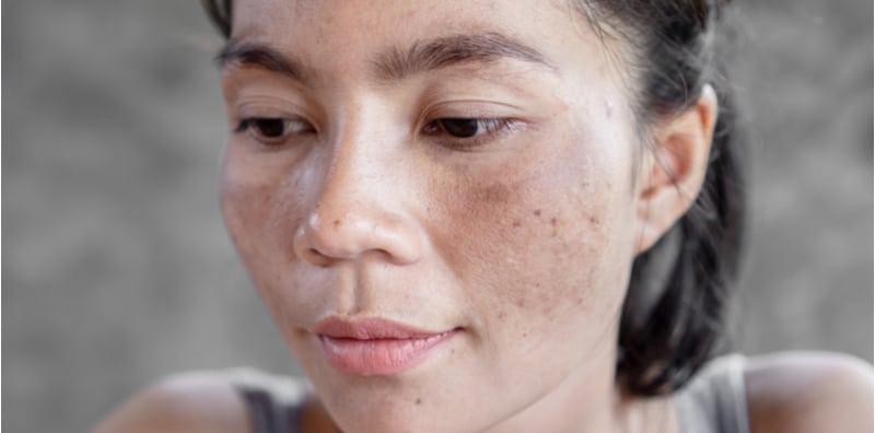 Jeragat Tak Nak Hilang, Cuba Guna 5 Bahan Semula Jadi Ini Untuk Membantu!