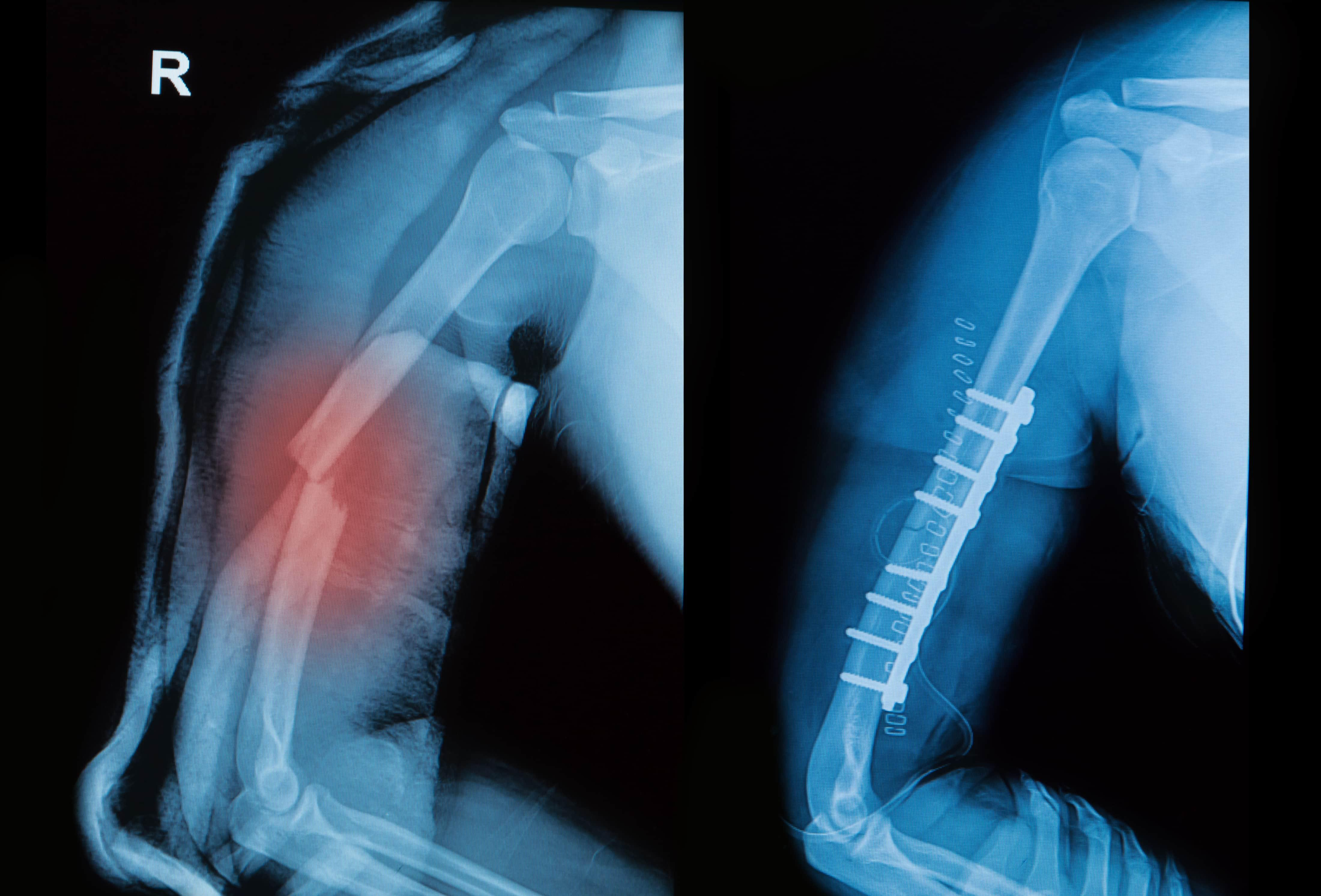 Arm Fractures