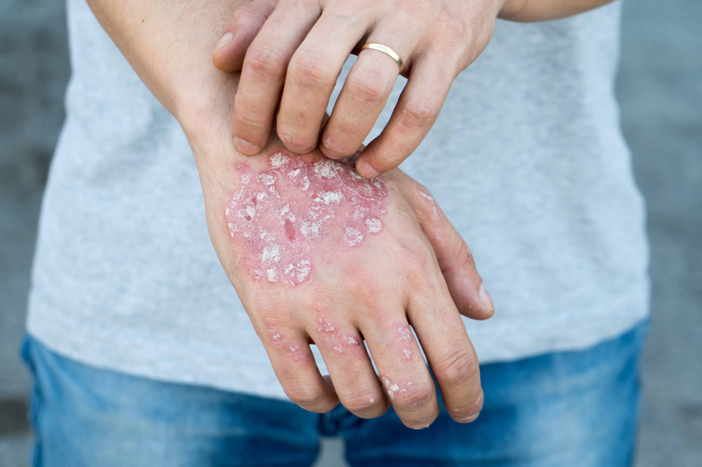 Chronic Diseases that Stem from Untreated Psoriasis