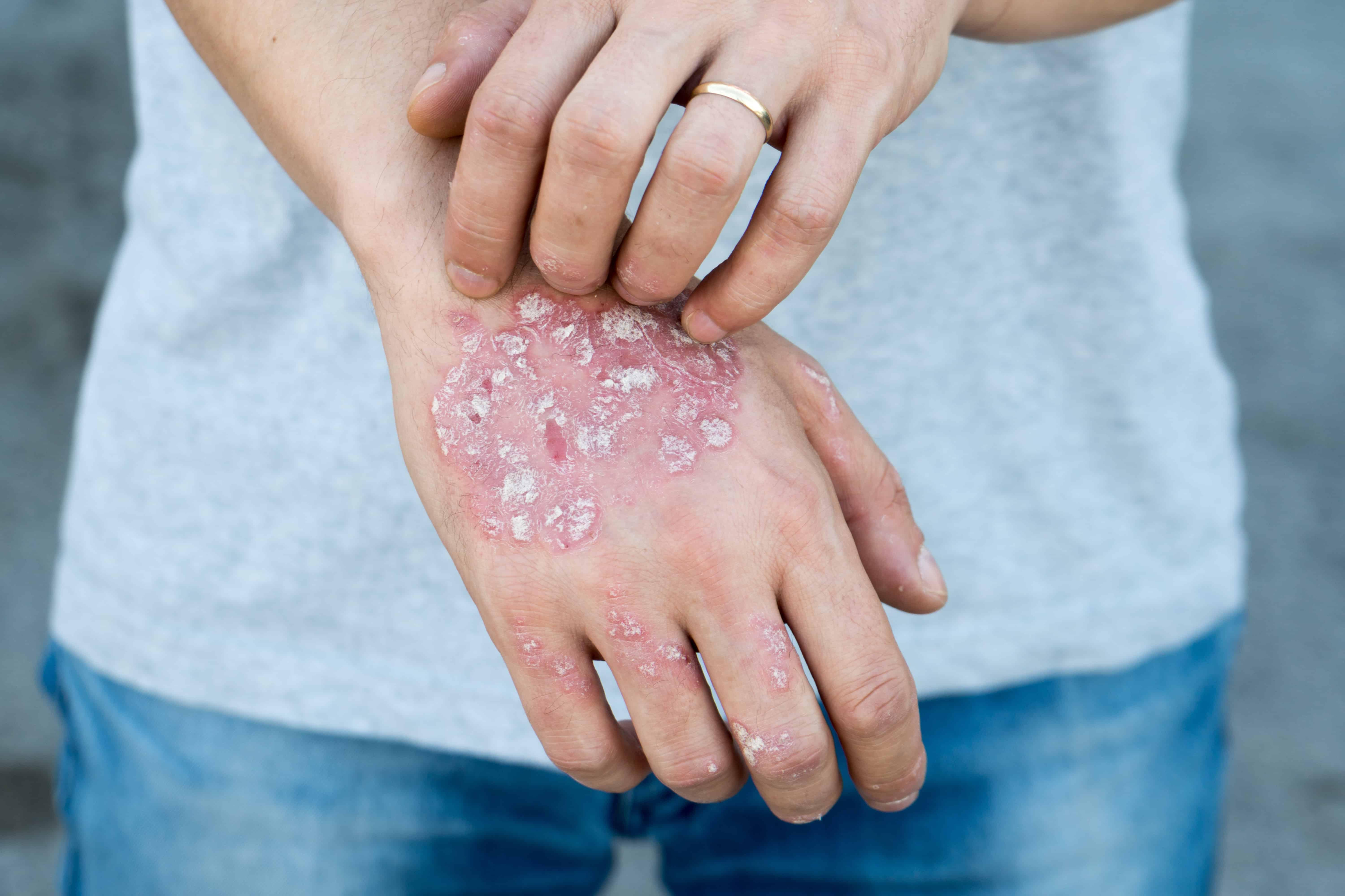 Chronic Diseases that Stem from Untreated Psoriasis