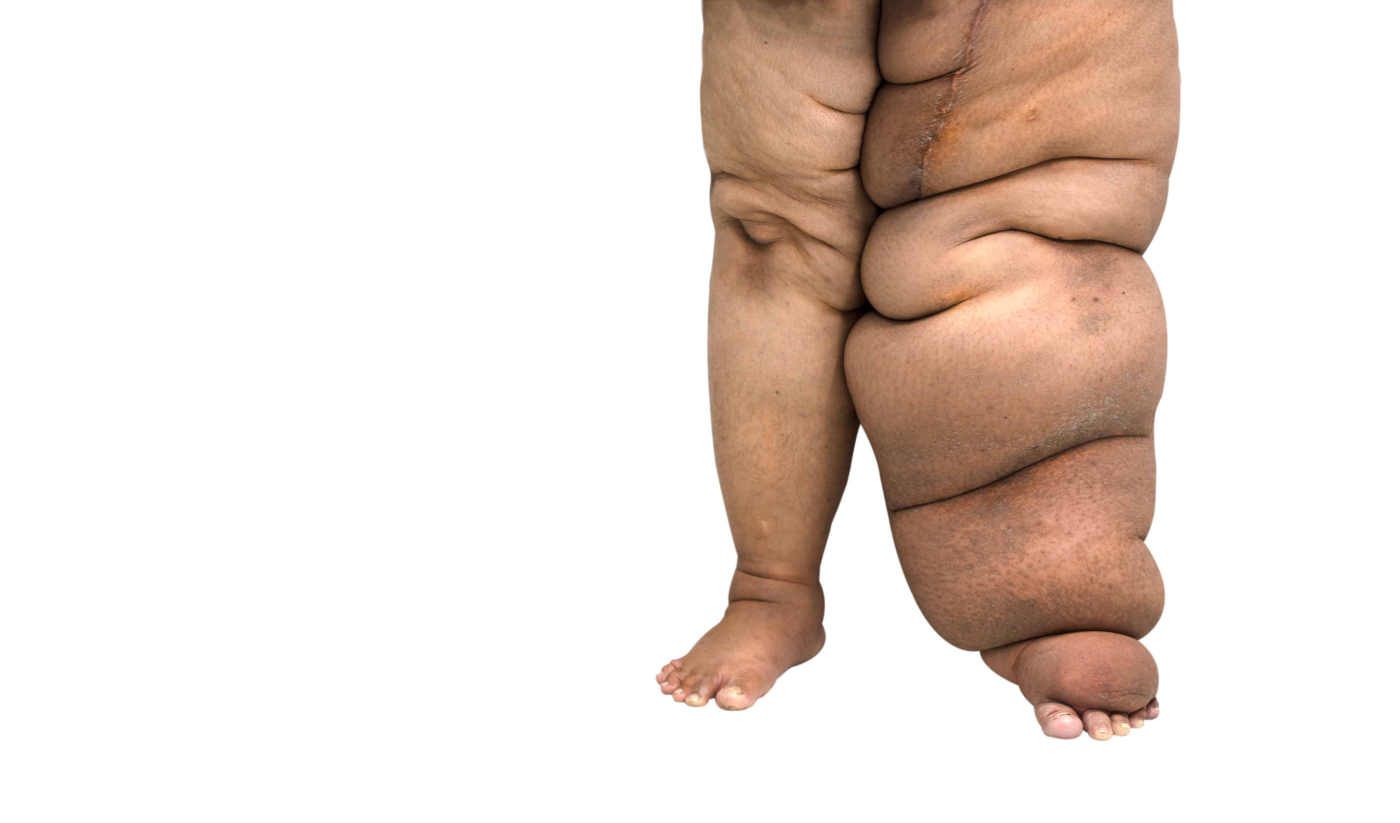 Elephantiasis: Penyakit Kaki Gajah Akibat Nyamuk