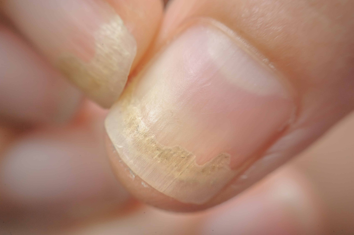 Nail Disorders Could be Telling You Something About Your Health
