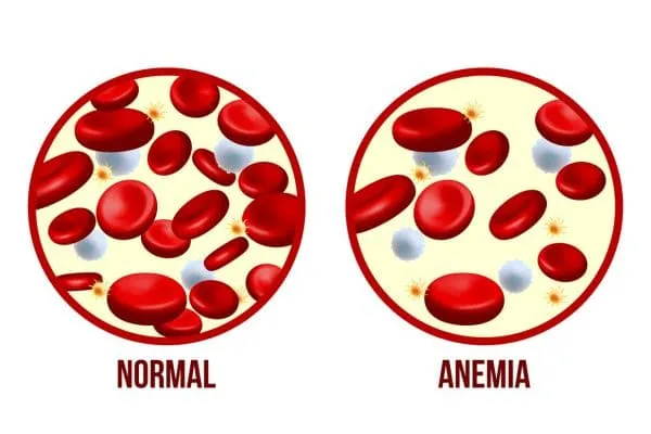 kesan anemia