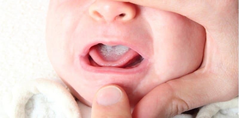 Mulut & Lidah Si Manja Ada Tompokan Putih? AWAS, Itu PUNCA Bayi Sukar Menyusu