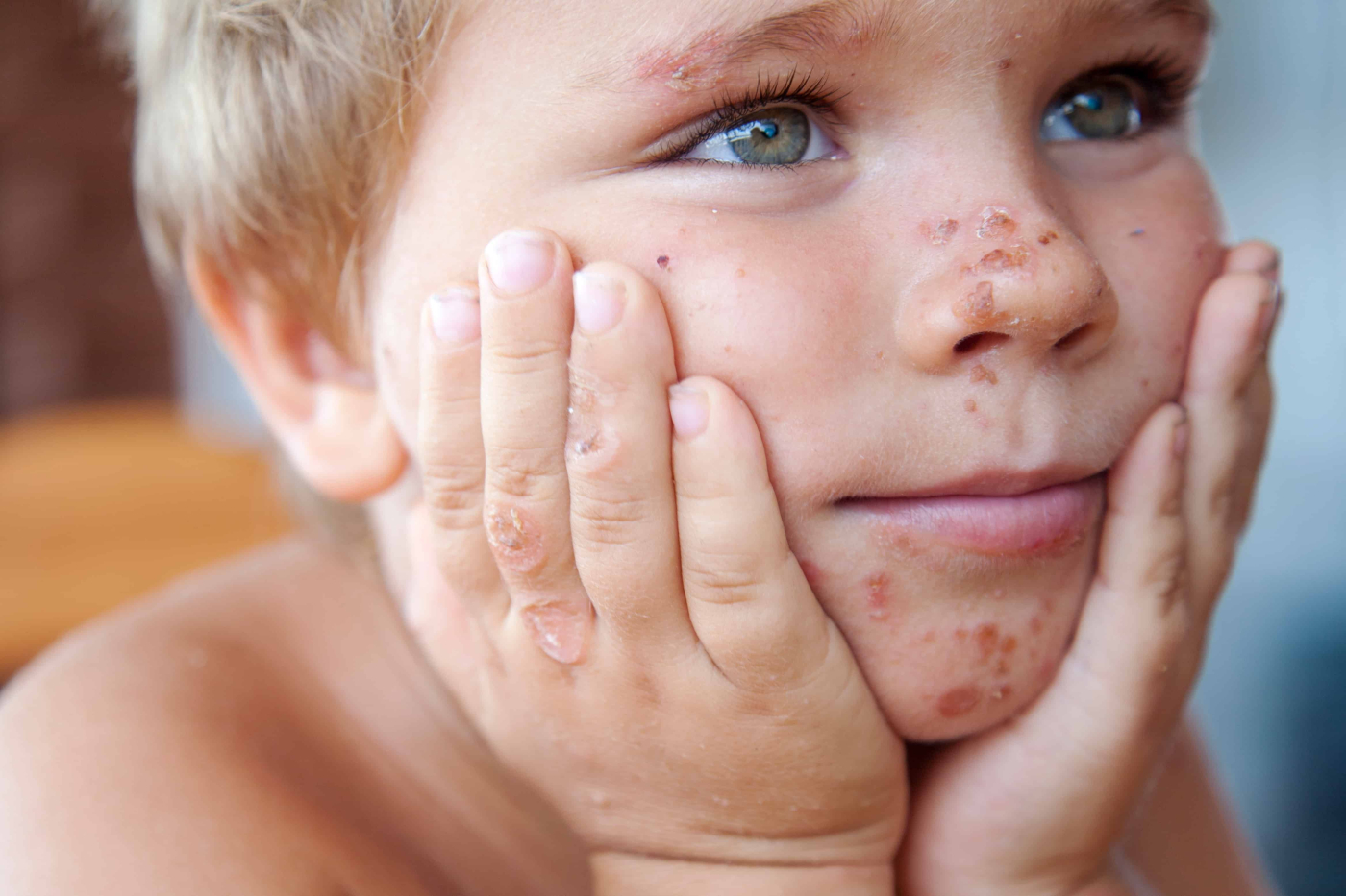 Trivial Skin Diseases that Could Worsen without Care