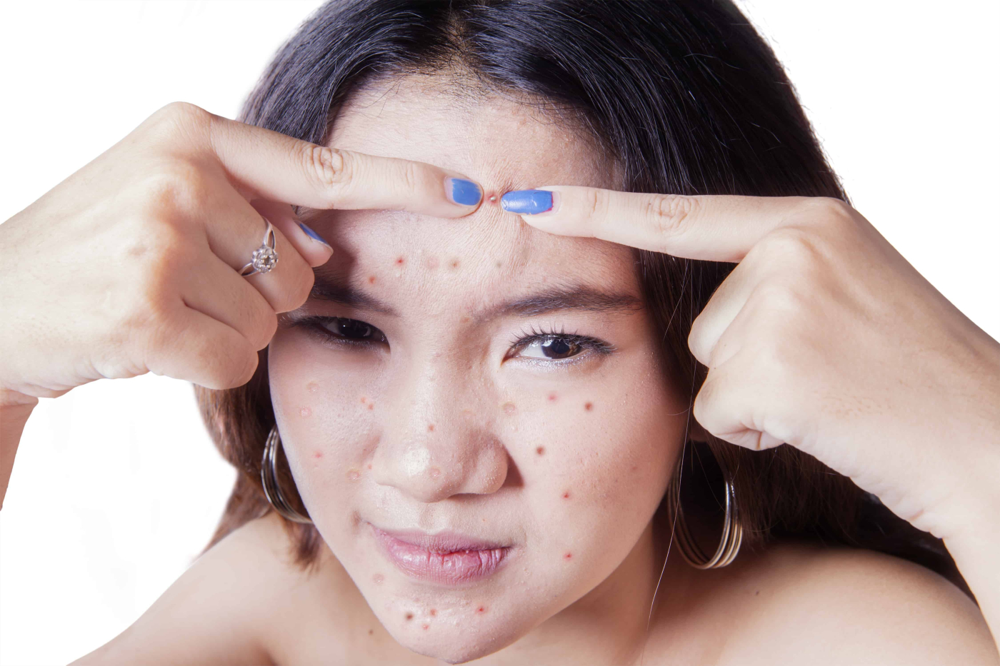 Top Tips for Teen Acne