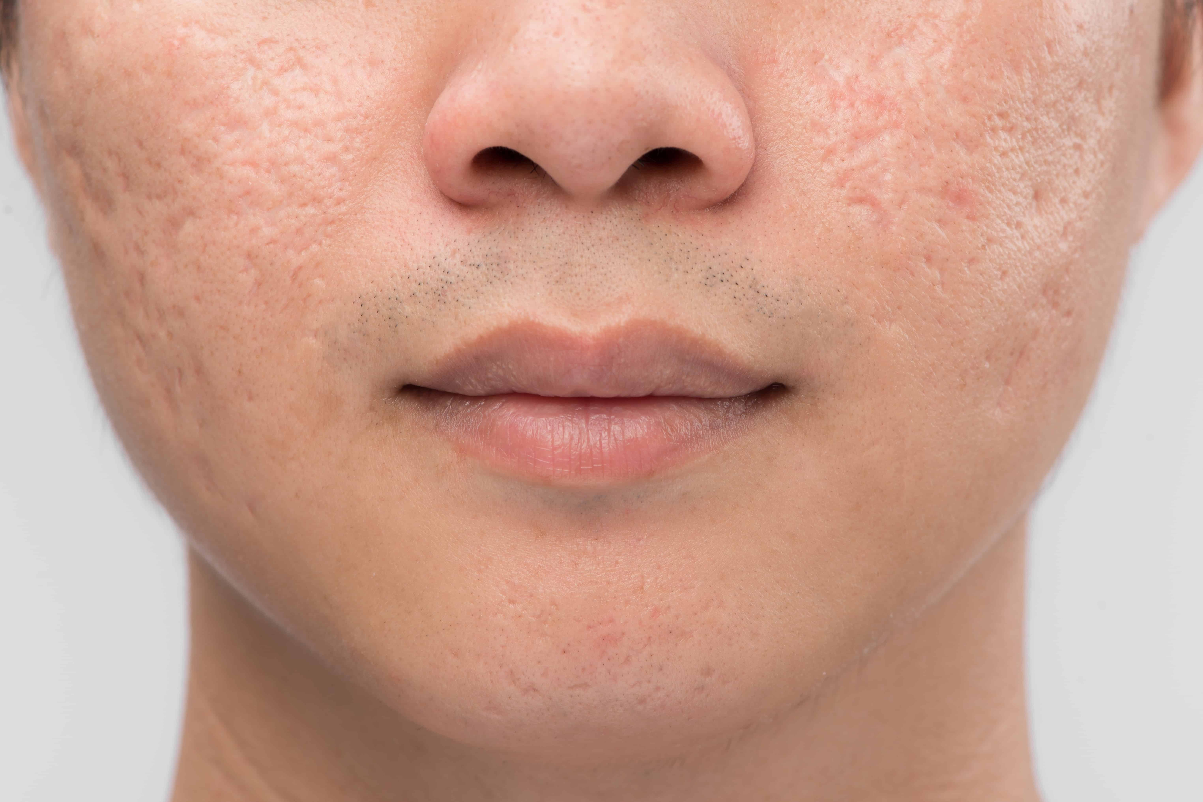 How to Cure Acne Scars