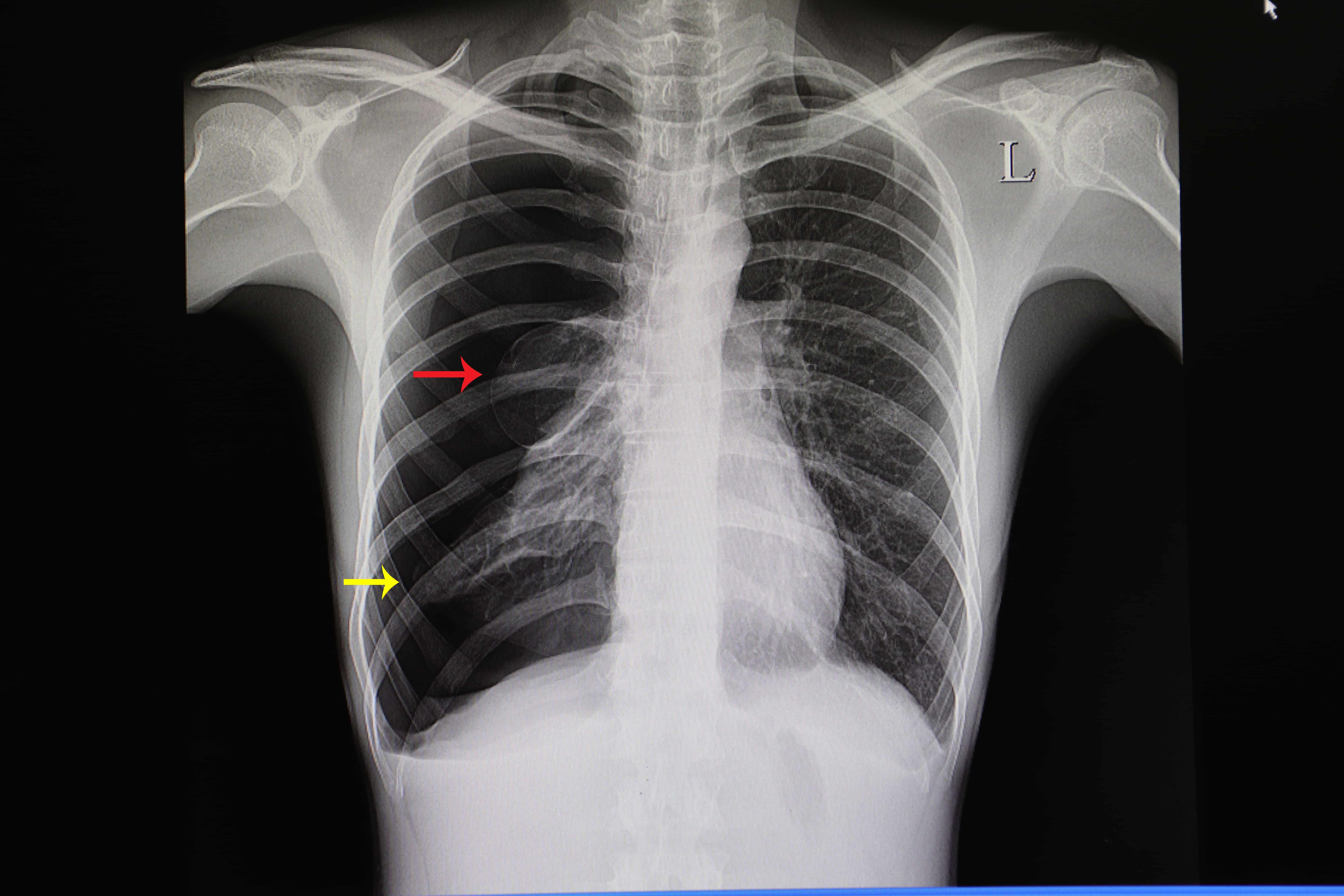 Chest X Ray Pneumothroax Or No Pneumothorax Youtube - vrogue.co