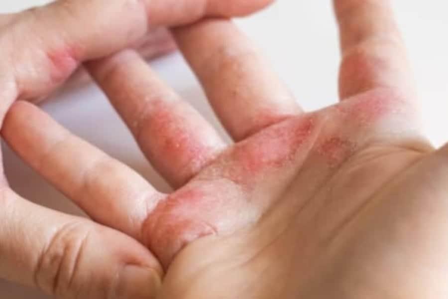 23 Pantang Larang Makanan Dan Minuman Untuk Penghidap Ekzema