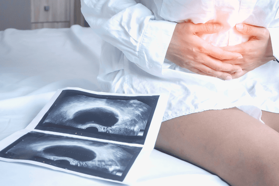 Elak Sista Ovari Pecah, Ini 5 Cara Kecutkan Cyst Yang Selamat Di Rumah!