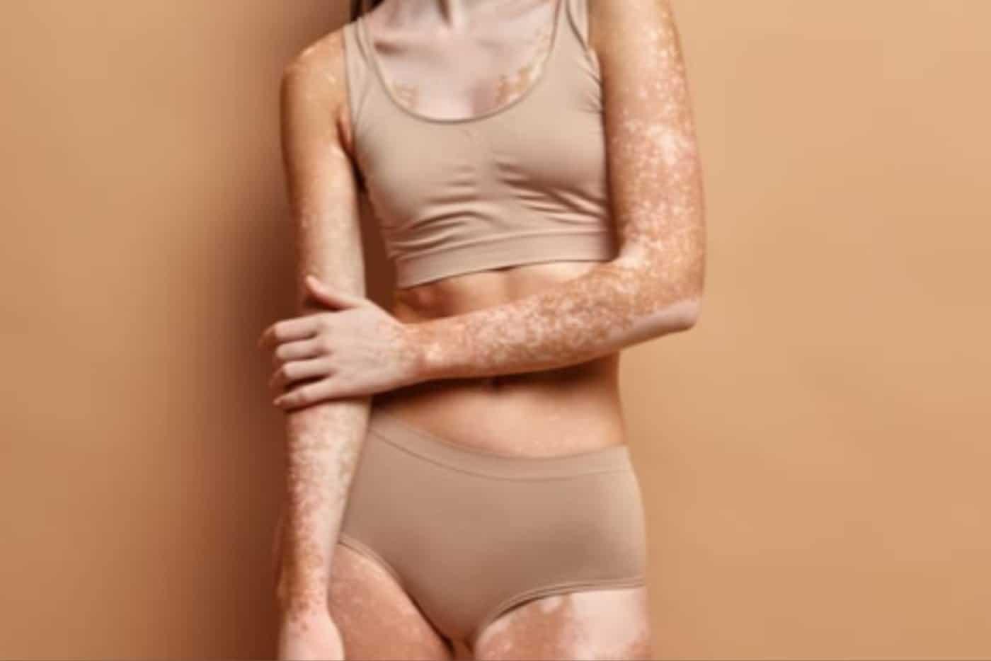 Rawatan Berkesan Untuk Pesakit Kulit Sopak, Caranya Jaga Makan & Ambil Vitamin!