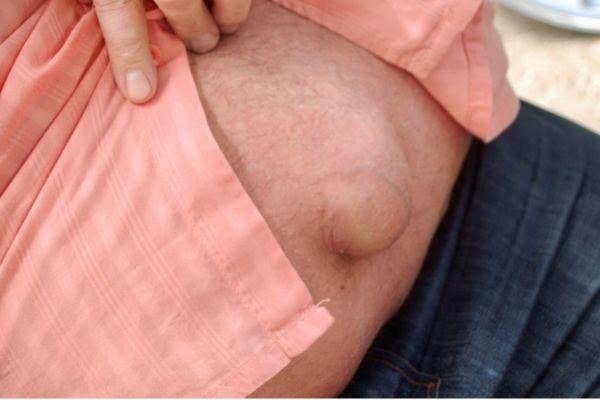apa itu hernia