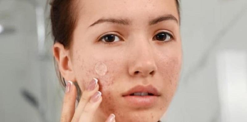Boleh Ke Atasi Masalah Jerawat Dengan Pimple Patch? Jom Selidik Keberkesanannya