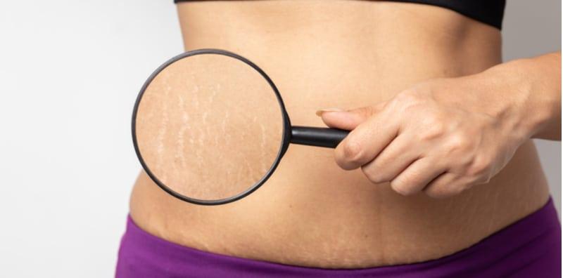 Selulit & Stretch Marks Berbeza, Ya! Ini 3 Cara Untuk Mencegahnya, Mudah Sahaja!