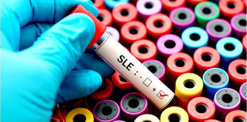 Penghidap Sakit Lupus TAK Boleh Makan Bawang Putih? Apa Lagi Pantang Lain?