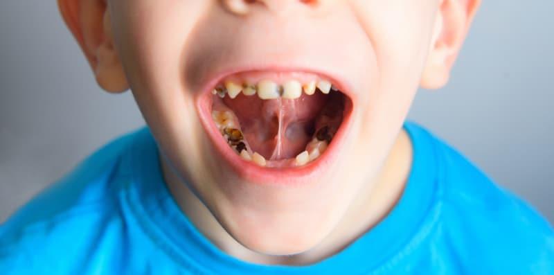 Cabut Gigi Susu Anak Walaupun Belum Goyang, Ini Risiko Pada Si Kecil Yang Parents WAJIB Tahu