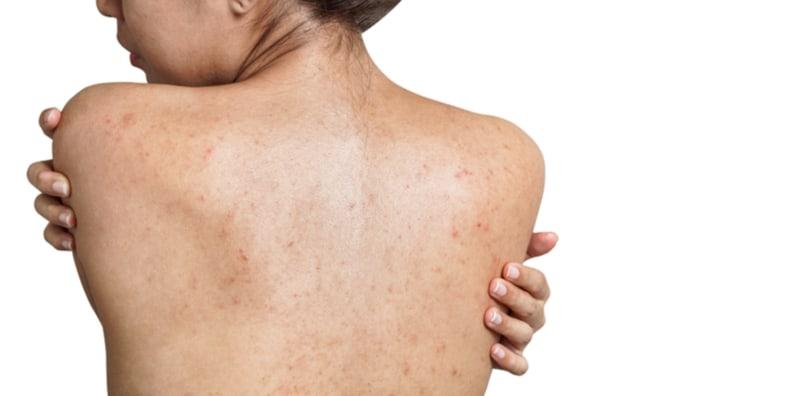 Kenapa Jerawat Muncul Pada Satu Badan? Untuk Cegah, Kena Tahu Punca Dulu!